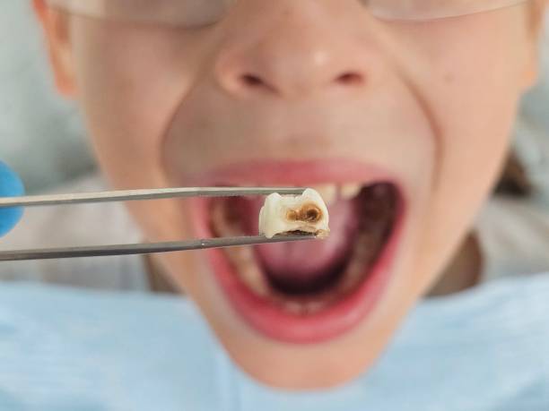 Best Emergency Treatment for Dental Infections or Abscesses in Posen, IL
